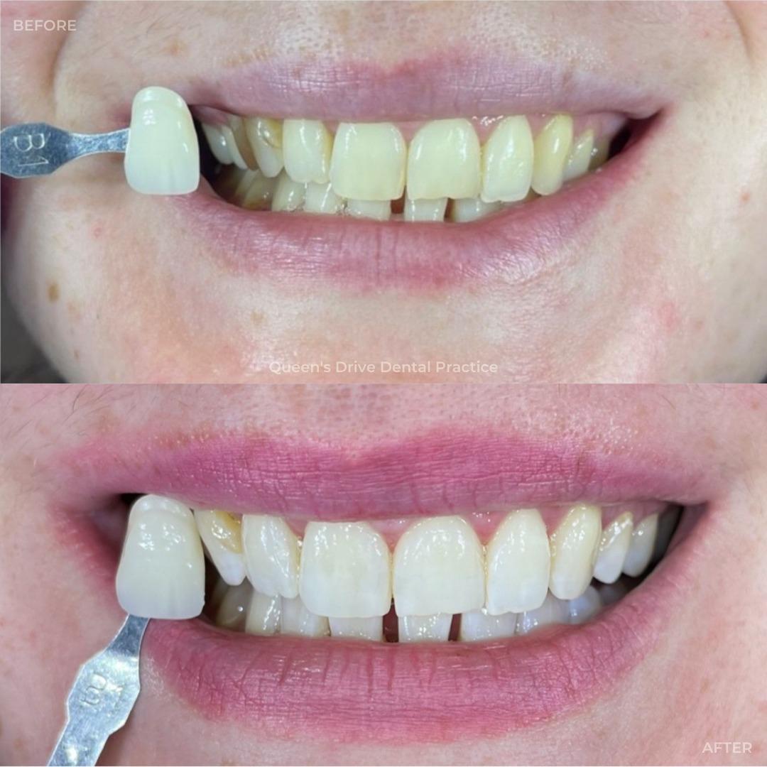 Queens Drive Dental Practice | Tooth whitening Get a brighter, whiter smile with Teeth Whitening