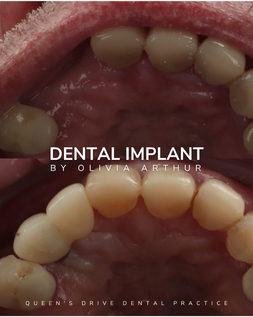 Queens Drive Dental Practice | Dental Implants Glasgow Before & After Dental Implant Treatment at Queens Drive in Glasgow