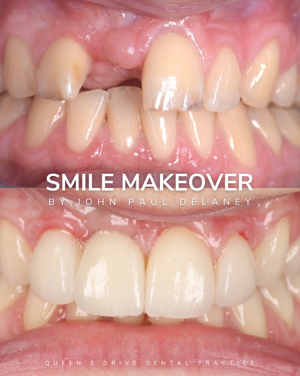 Queens Drive Dental Practice | Dental Implants Glasgow Before & After Dental Implant Treatment at Queens Drive in Glasgow