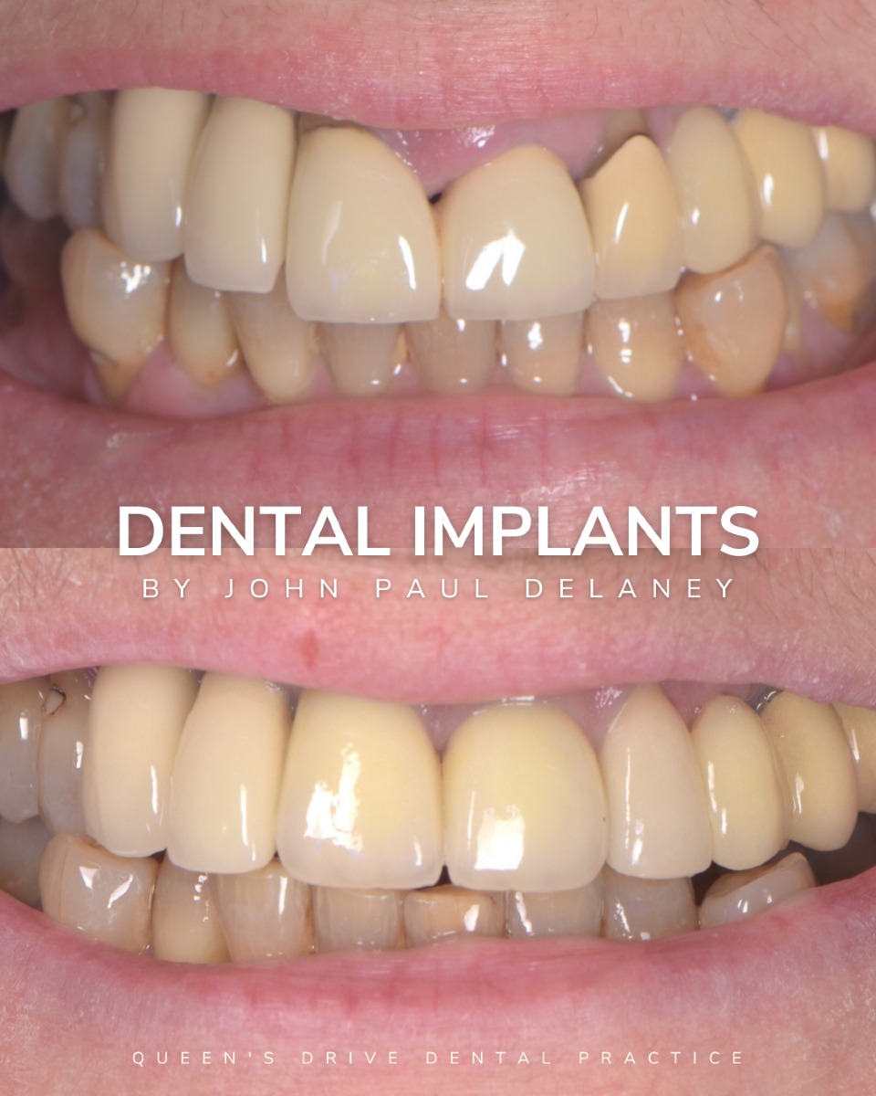 Queens Drive Dental Practice | Dental Implants Glasgow Before & After Dental Implant Treatment at Queens Drive in Glasgow