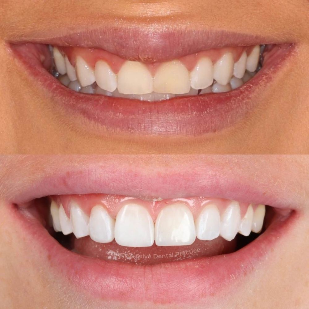 Queens Drive Dental Practice | Queens Drive Dental Practice, Glasgow Before and after treatment at Queens Drive Dental in Glasgow